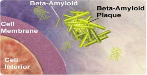 beta amyloid plaque