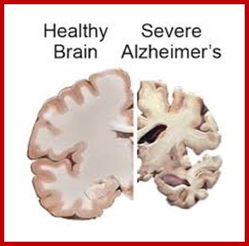 Image result for alzheimer plaques and clumps in patients