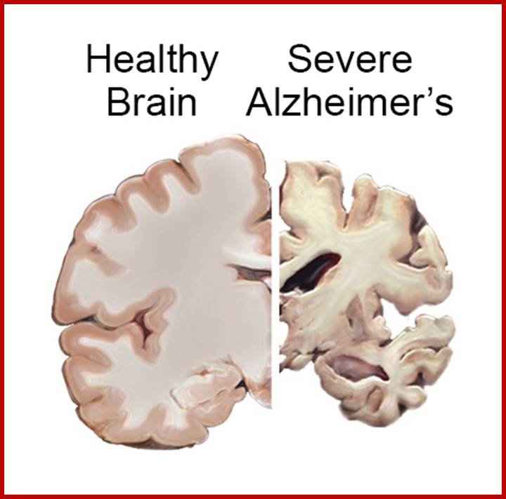Image result for Causes and effect of Alzheimer's disease